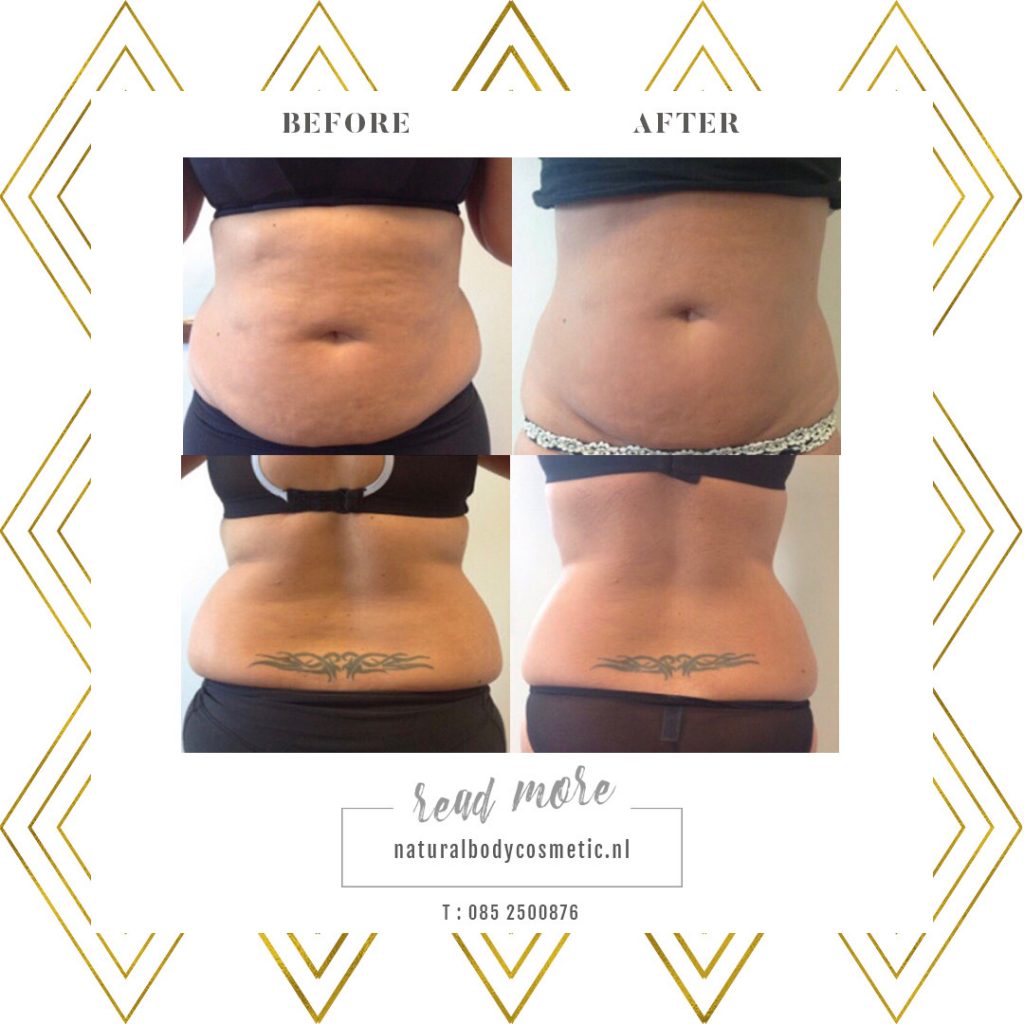 Cavitatie & Lipo laser slimming